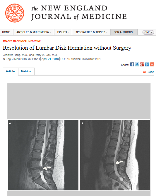 The NEW ENGLAND JOURNAL of MEDICINE - Resolution of Lumbar Disk Herniation without Surgery MRI scan image 