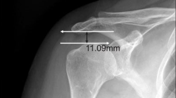 Shoulder x-ray shows acromiohumeral space.